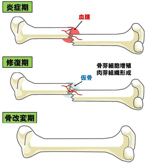 北垣骨傷